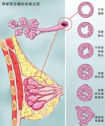 乳腺癌初期症状及自检方法