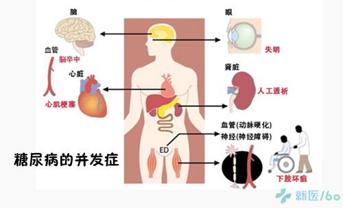 糖尿病可疑信号有哪些？